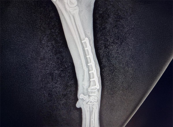 9 - Fracture Case LeiLOX 2.0 mm Titanium Locking Plate - Dr. Jeff Mayo