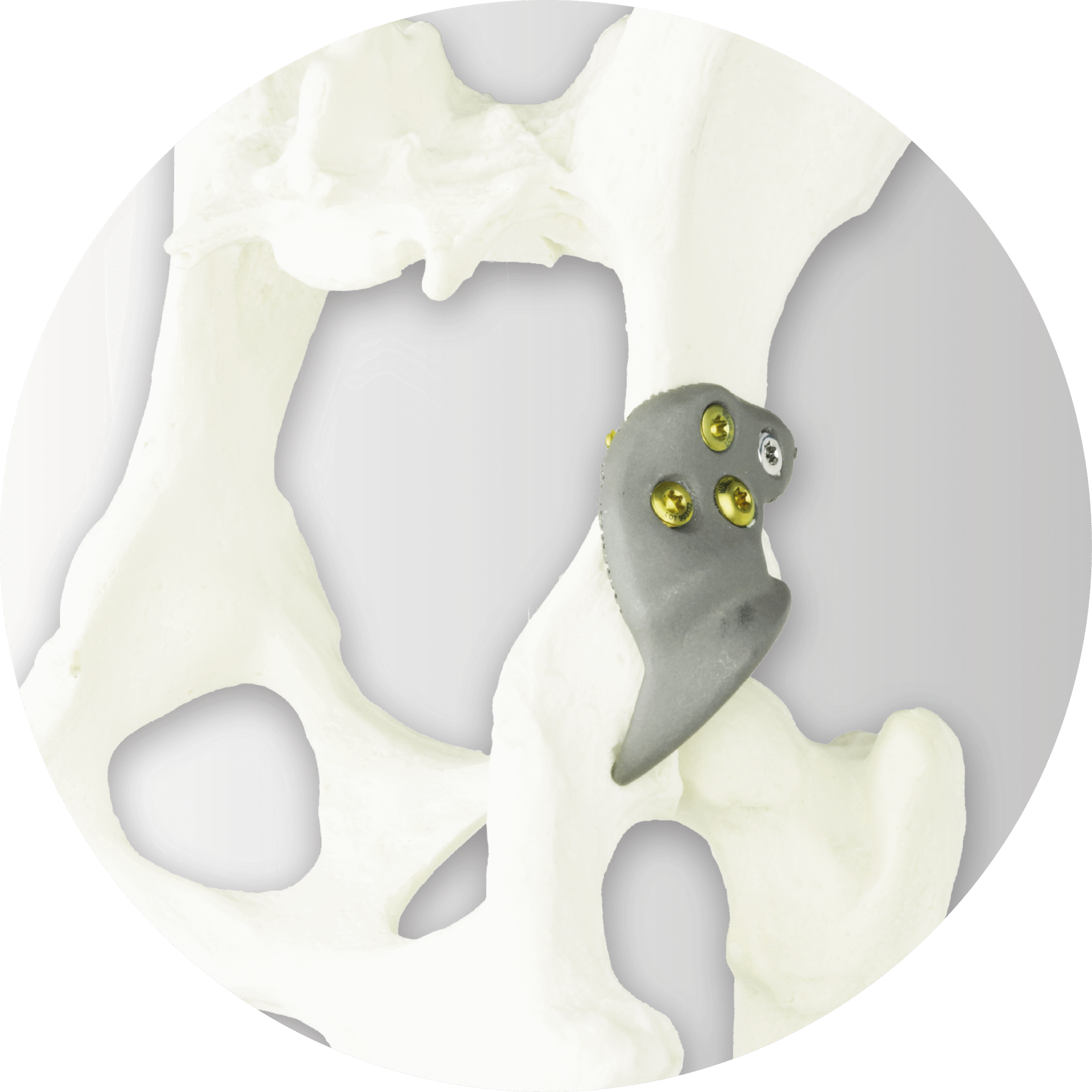 3D HIP image_2 3D HIP Implant on Sawbone Model