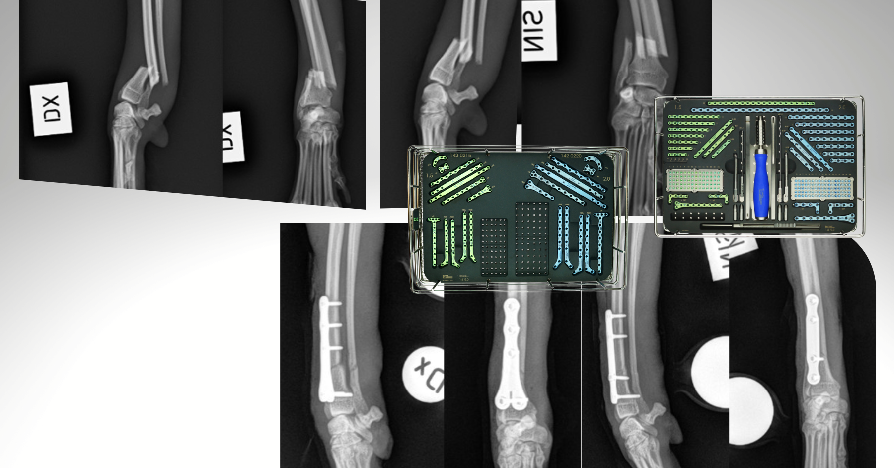 3D HIP Shelf Implant