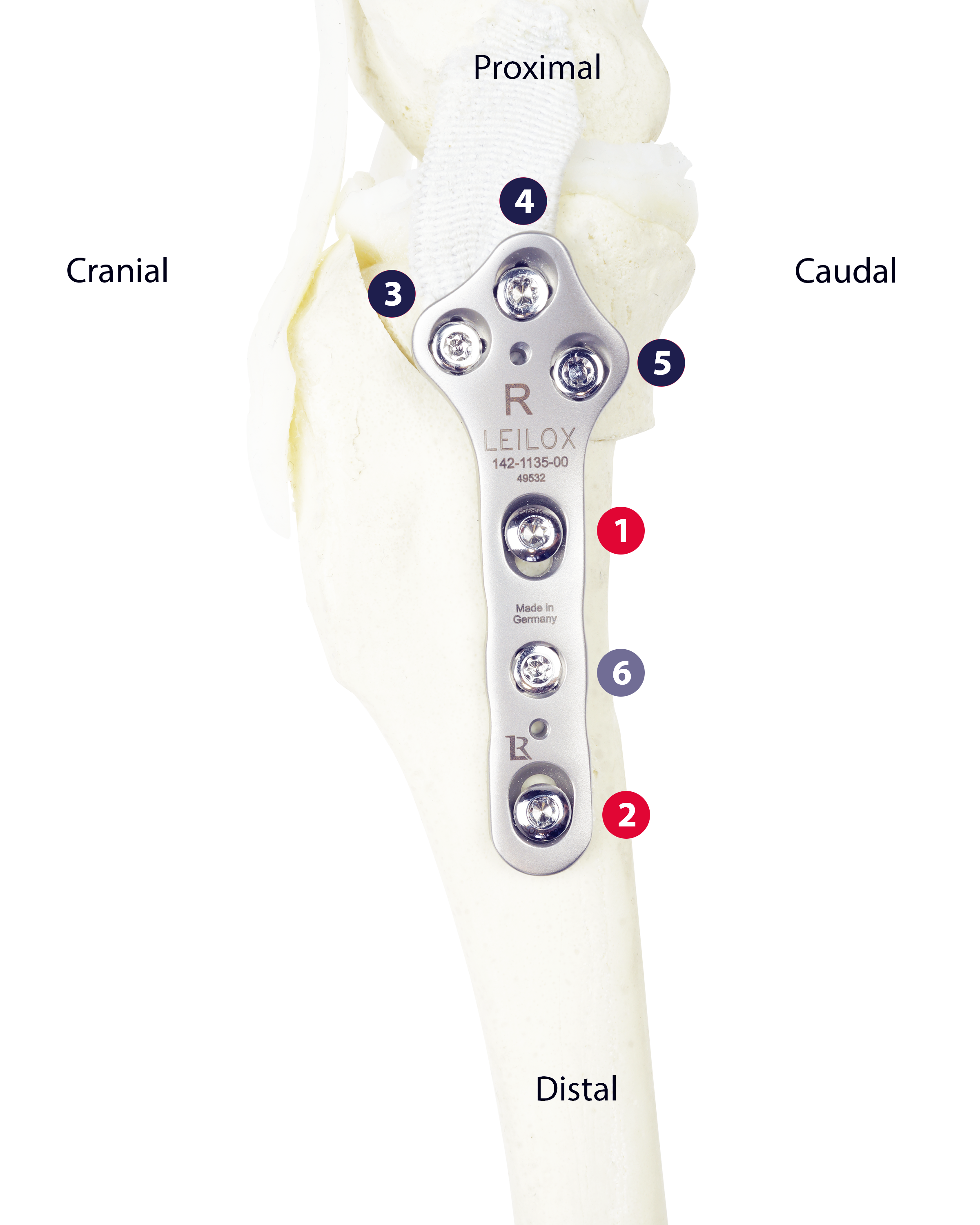 Screw Insertion Sequence