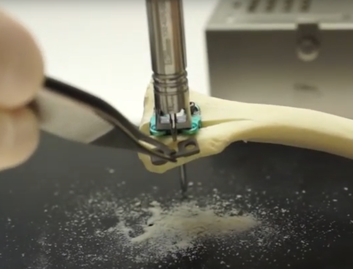 TTA RAPID and RAPID LUXATION_1