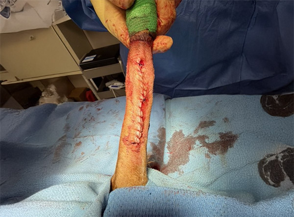 7 - Fracture Case LeiLOX 2.0 mm Titanium Locking Plate - Dr. Jeff Mayo