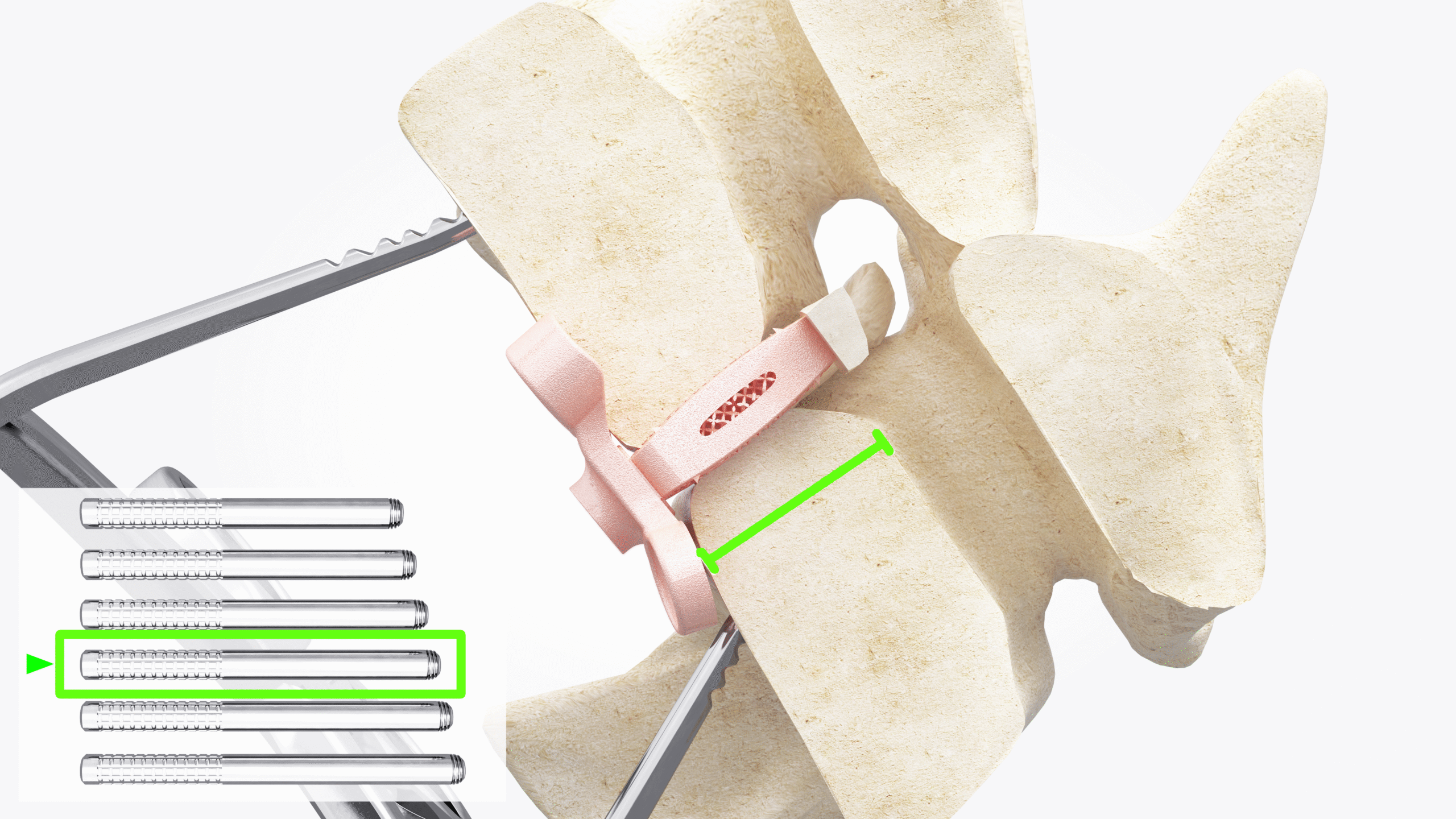 7_Remove disractor and rod