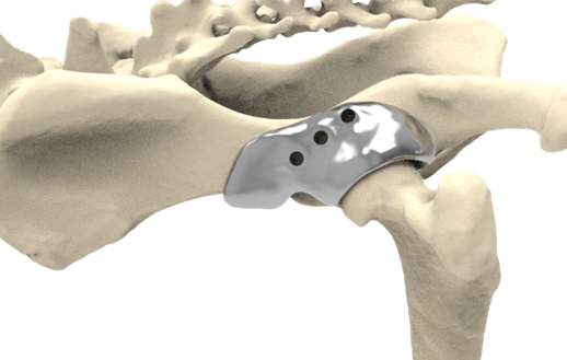 3D HIP Shelf Implant