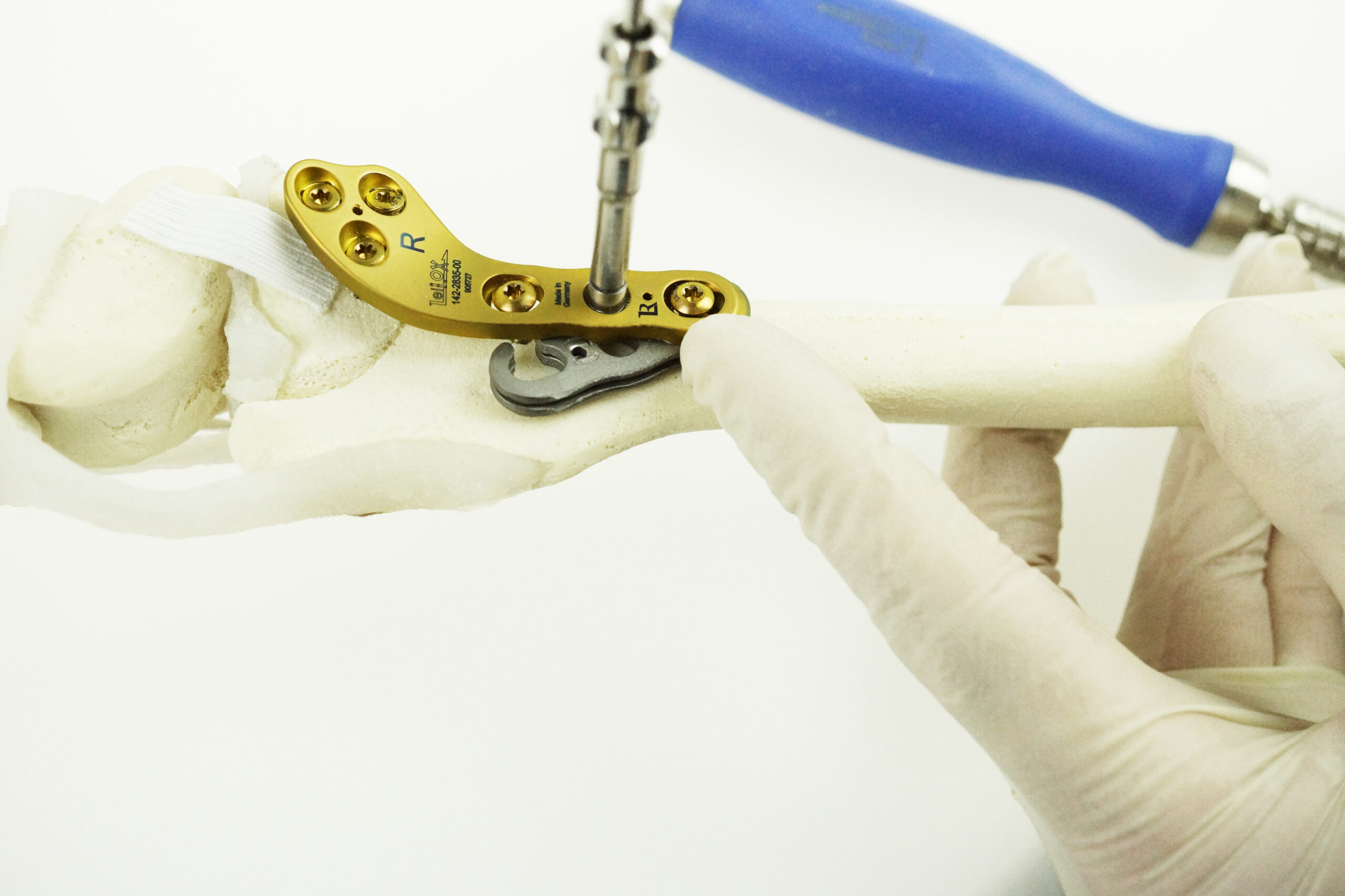 TPLO Pat Lux_1_Spacer Insertion_2