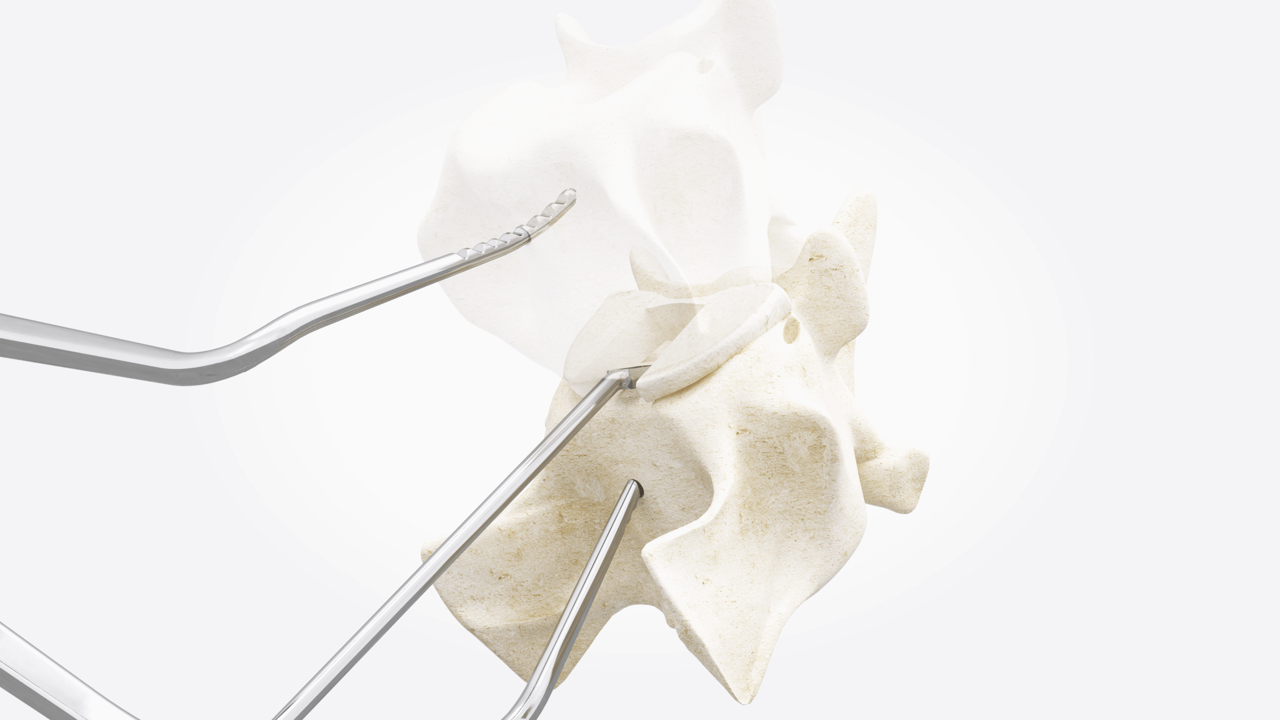 4_Remove remnants of nucleus pulposus