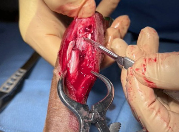 2 - Fracture Case LeiLOX 2.0 mm Titanium Locking Plate - Dr. Jeff Mayo