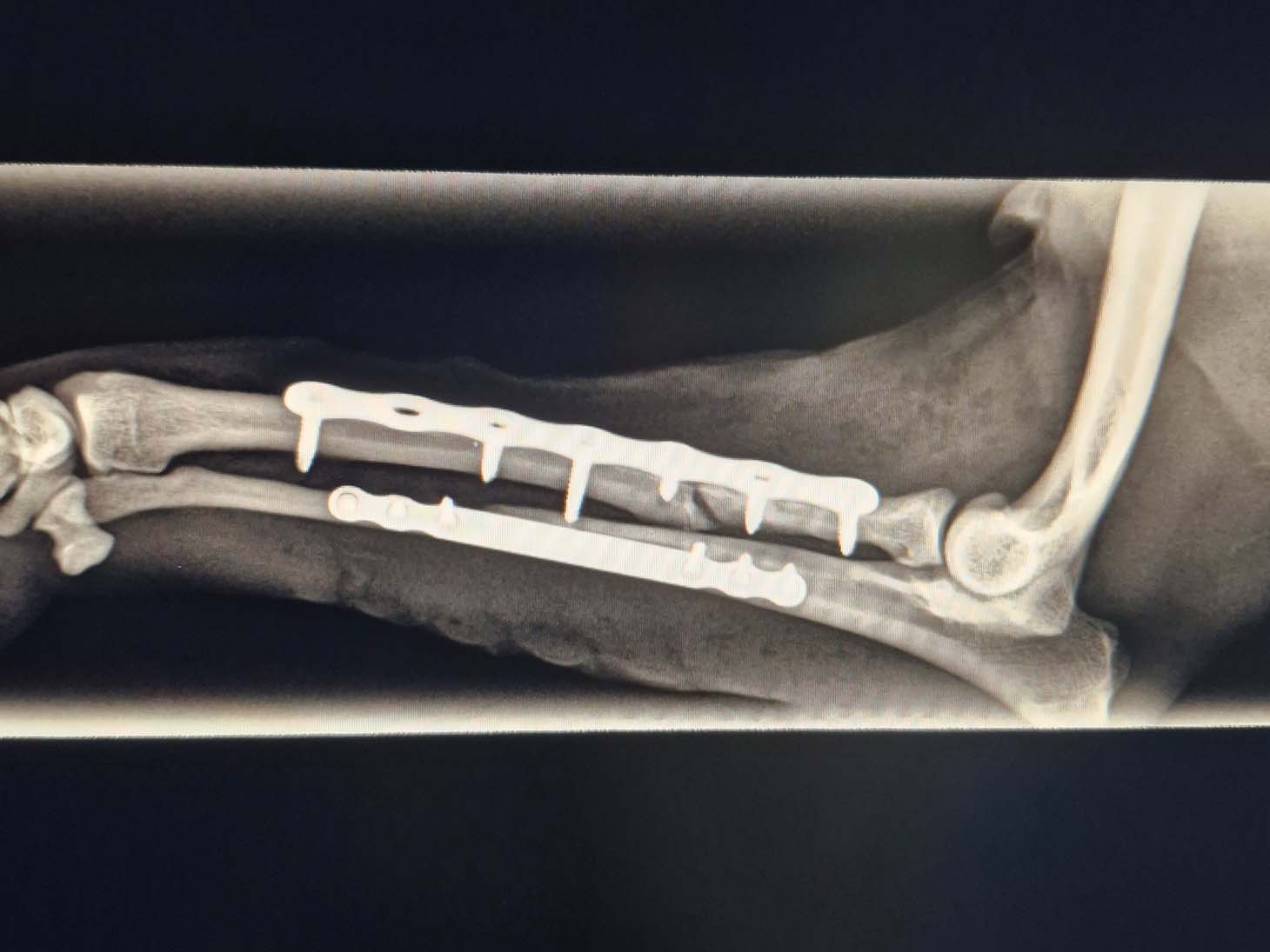 6 - Rita Leibinger Medical - New 1.0 mm LeiLOX Plate